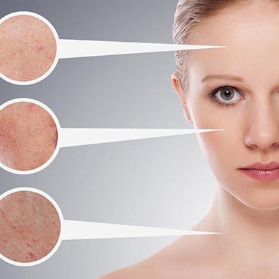 À la clinique laser St-Jérôme, le traitement de couperose se fait avec une machine au laser moderne et efficace