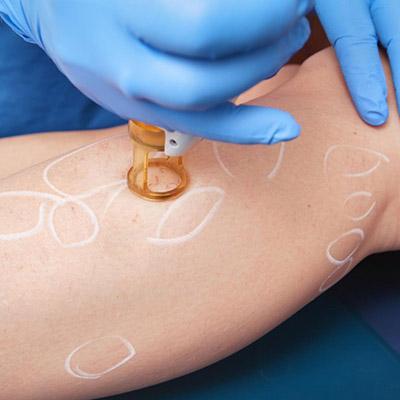 Dites adieu aux problèmes de varice, de couperose, d’angiome stellaire et de point de rubis grâce aux traitements vasculaires